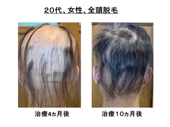 円形脱毛症　病院